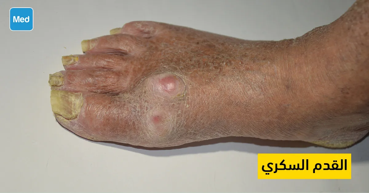 القدم السكري 